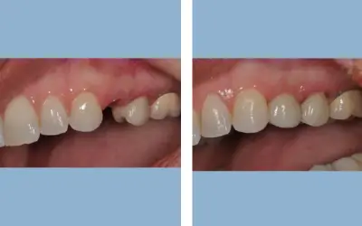 Before and After